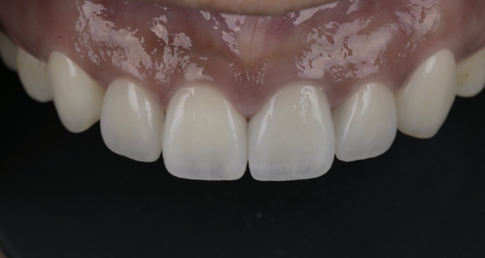 牙冠增長手術