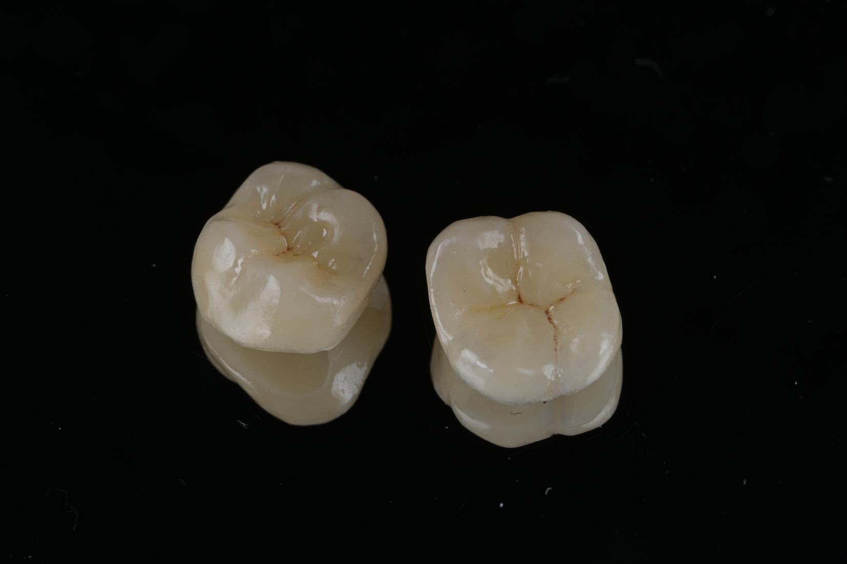 後牙全瓷冠咬合面
